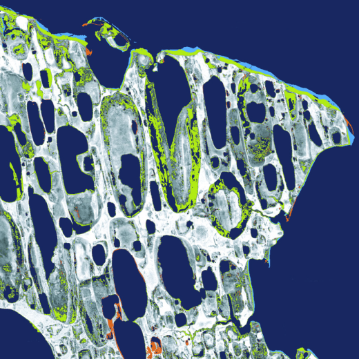 Arctic permafrost -- hard, permanently frozen ground -- thaws and collapses as temperatures rise, forming sinkholes that destroy homes, highways and pipelines. In low-lying areas, seawater inundates sinking areas of melted permafrost. In this Landsat image of Cape Halkett, along the north coast of Alaska, green and light blue indicate land lost to permafrost melting between 1955 and 2005. Heat-trapping greenhouse gases held within the permafrost, such as carbon dioxide and methane, are released when it melts, further contributing to atmospheric warming. Methane is 25 times more potent per molecule than carbon dioxide as a greenhouse gas. If the high northern latitudes continue warming at current rates, the region's soils will release more carbon dioxide and methane into the atmosphere, which could accelerate global warming.

Image taken by the Landsat satellite.
Credit: Mars/Houseknecht, USGS.